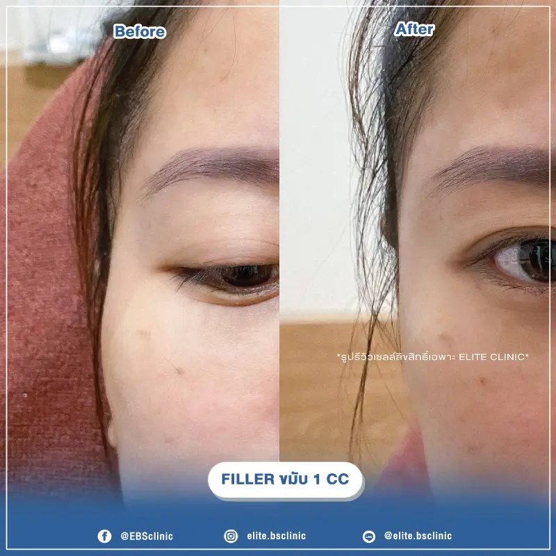 Filler ขมับ 