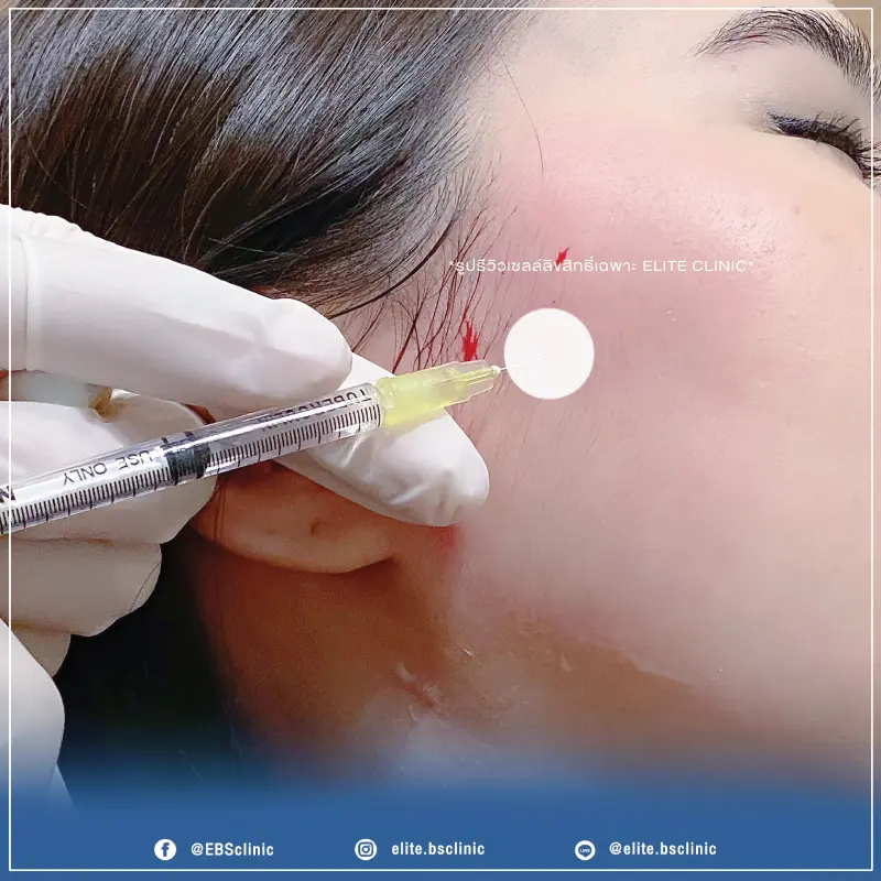 Botox