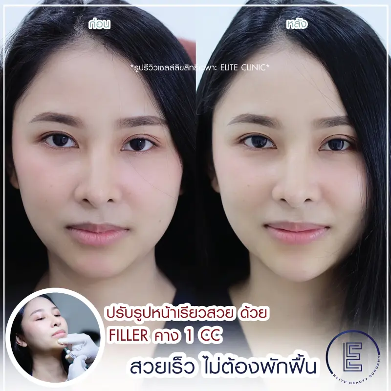 Filler คาง