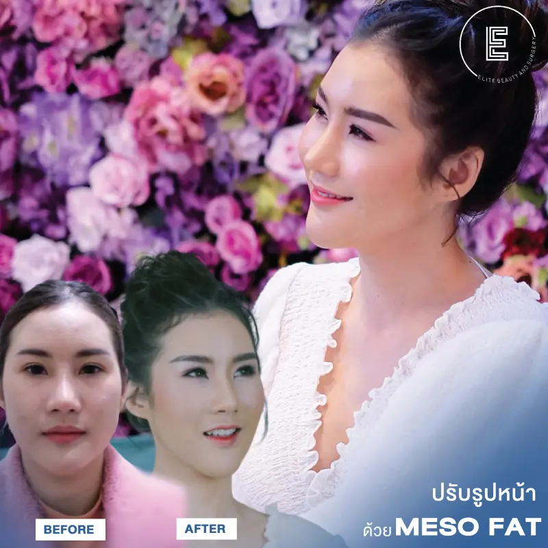Meso Fat 