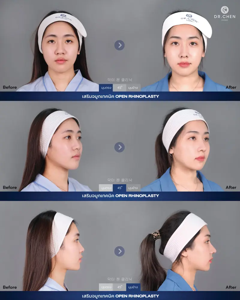 Open Rhinoplasty