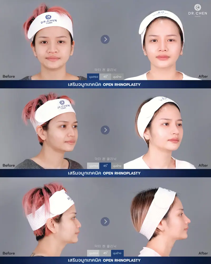 Open Rhinoplasty