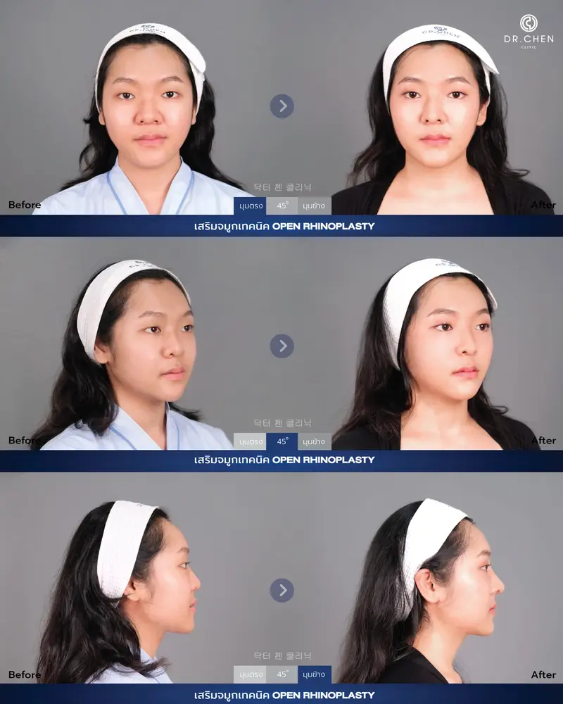 Open Rhinoplasty