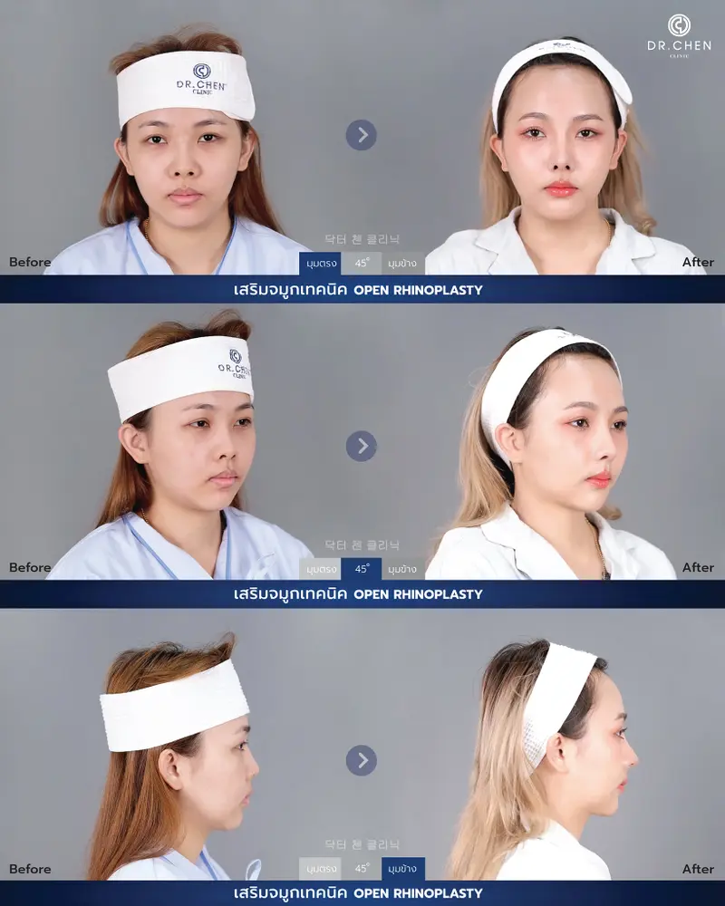 Open Rhinoplasty
