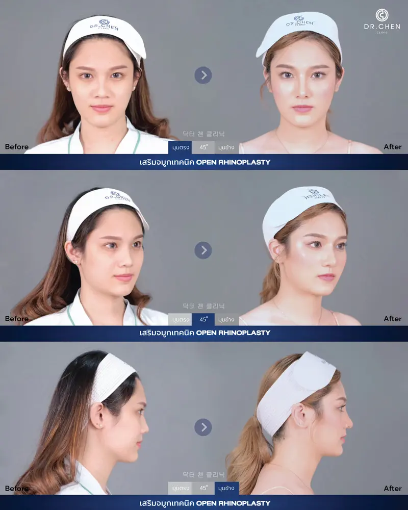 Open Rhinoplasty