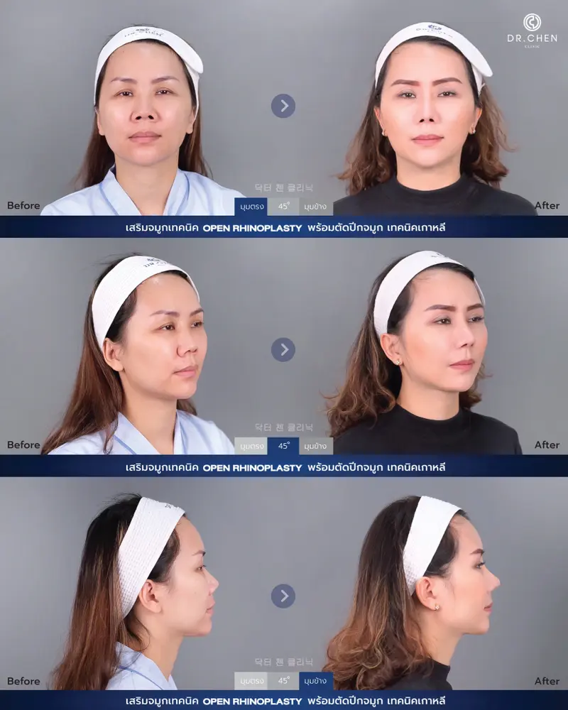 Open Rhinoplasty