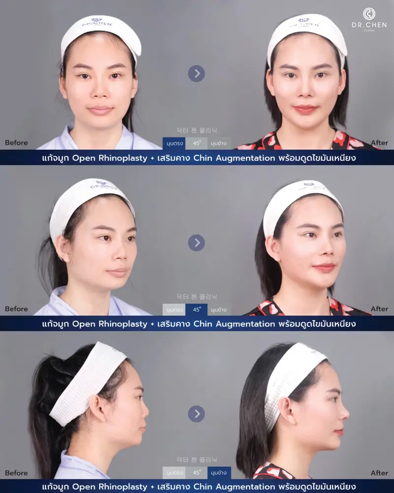 Revision Open Rhinoplasty
