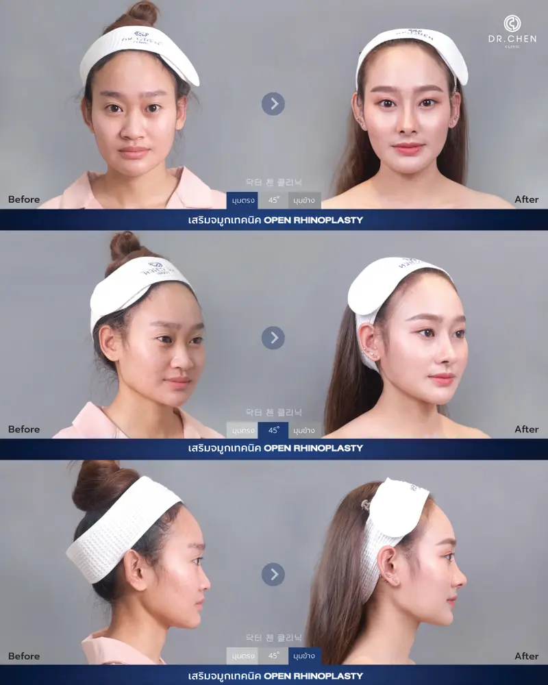 Open Rhinoplasty