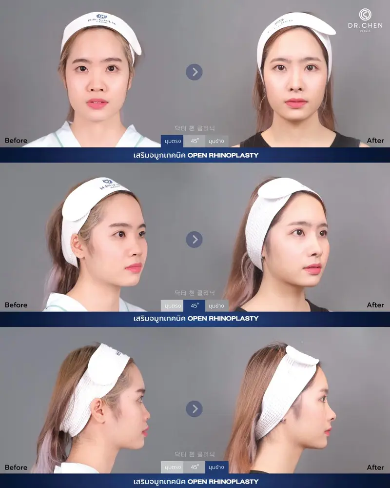Open Rhinoplasty