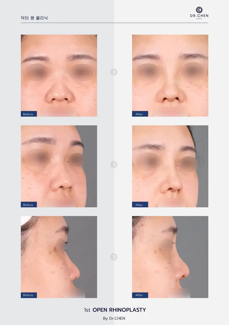 Open Rhinoplasty