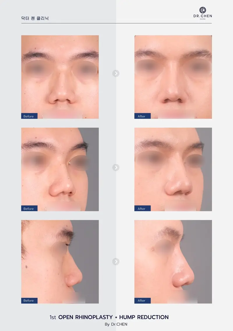 Open Rhinoplasty