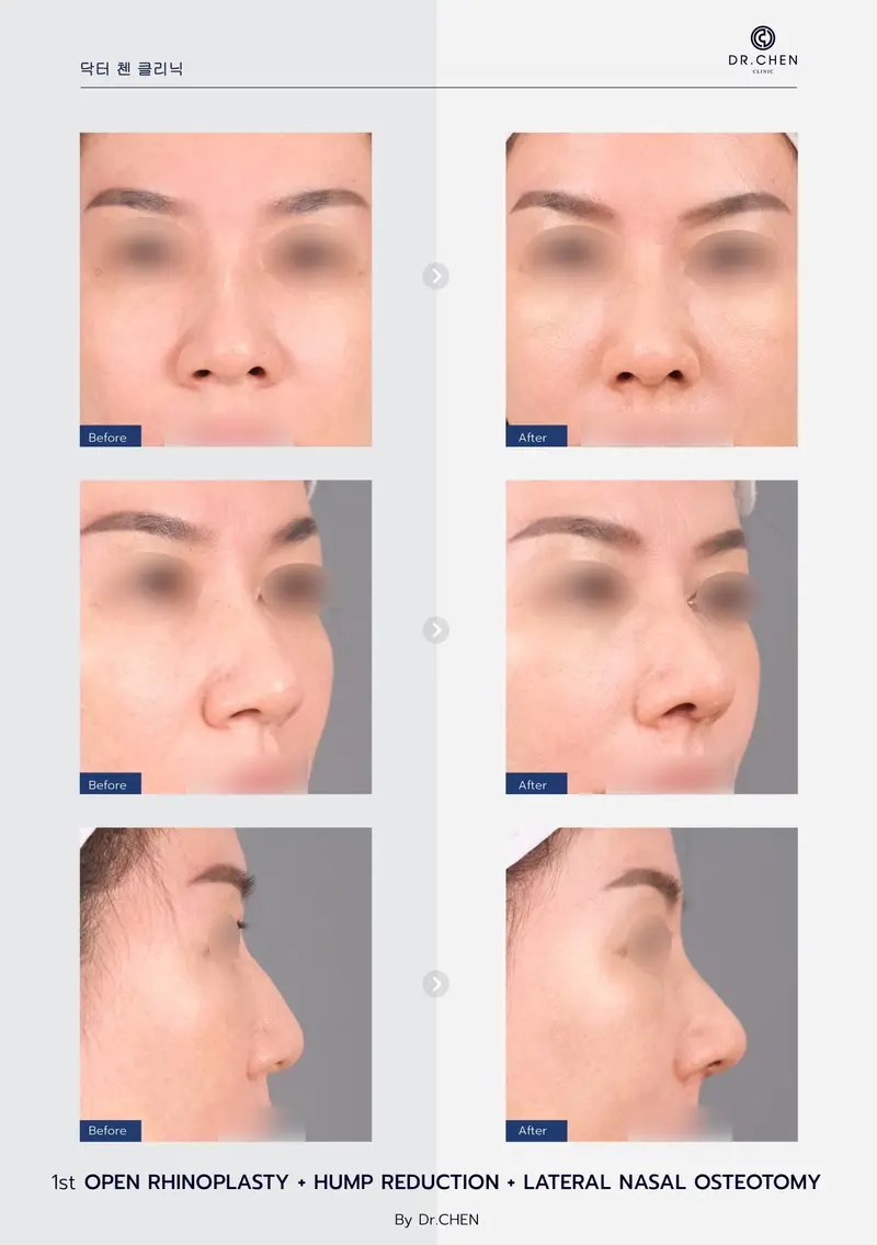 Open Rhinoplasty