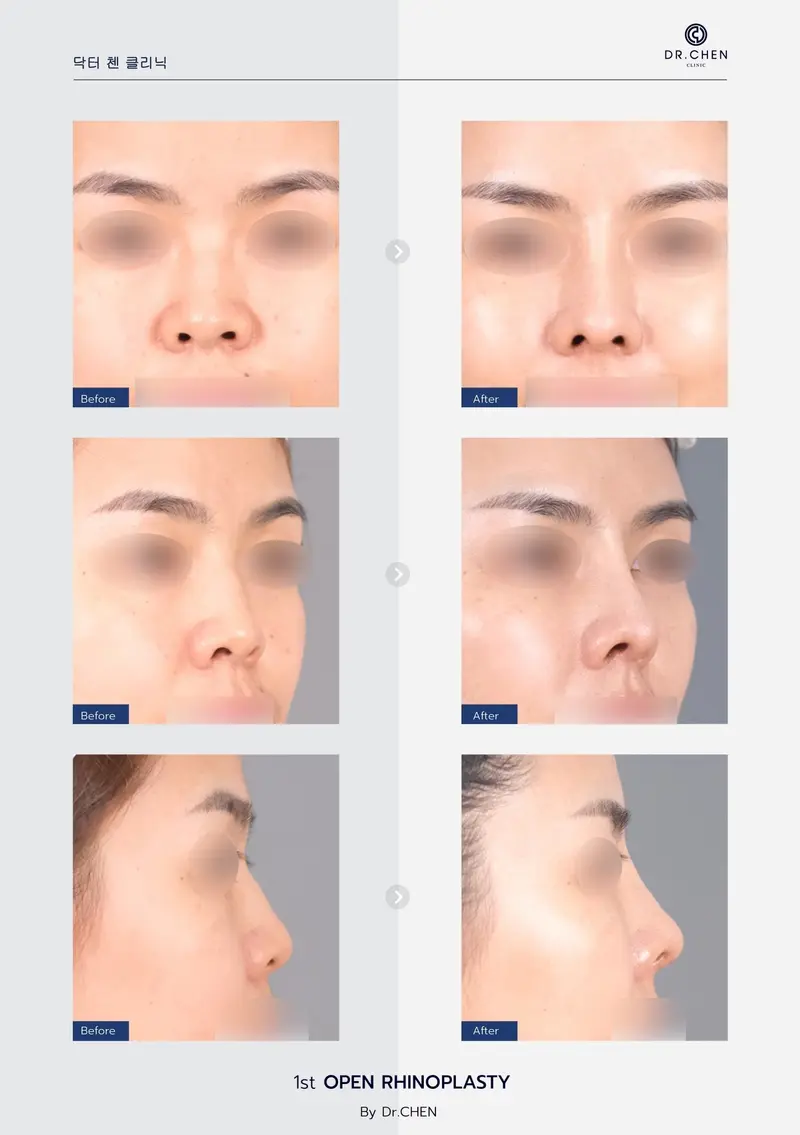 Open Rhinoplasty