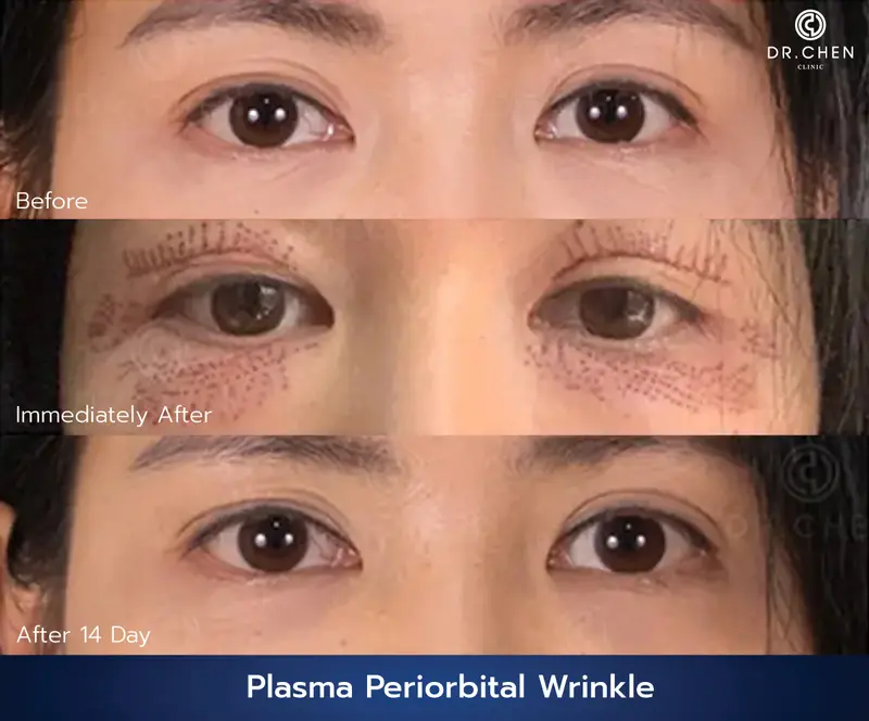 รักษาริ้วรอย Plasma Periorbital Wrinkle