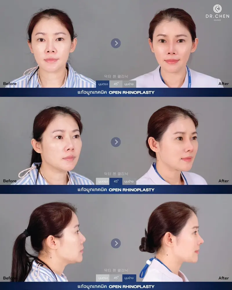 แก้จมูก Open Rhinoplasty