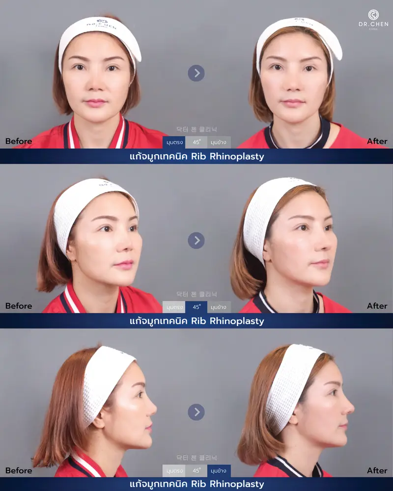 แก้จมูก Hybrid Rib Rhinoplasty
