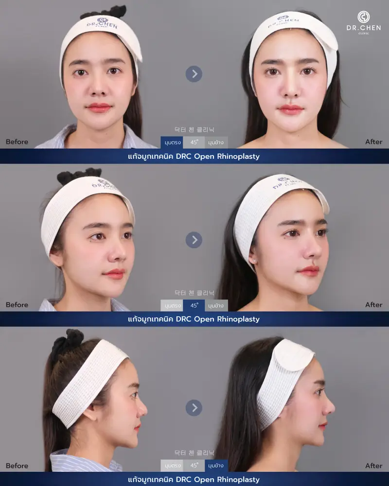 ศัลยกรรมจมูกเทคนิค DRC Open Rhinoplasty
