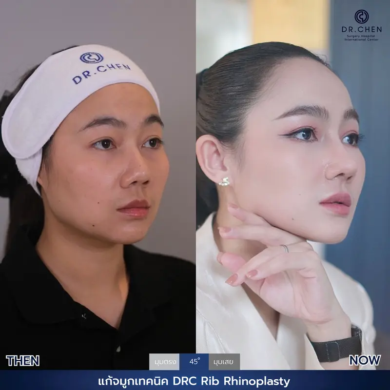 แก้จมูกเทคนิค DRC Rib Rhinoplasty 