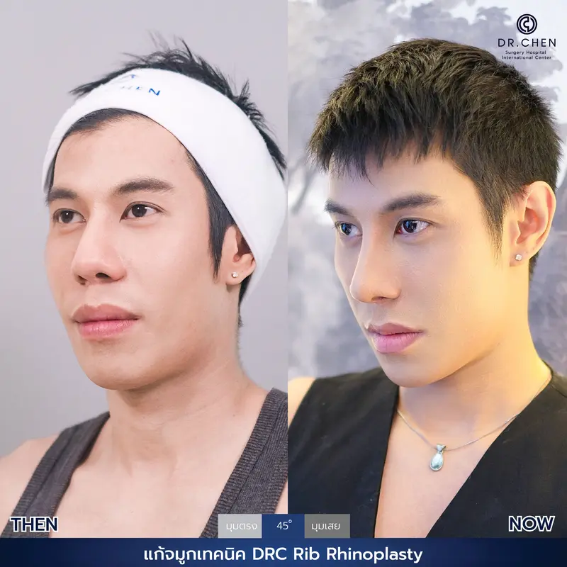 แก้จมูกเทคนิค DRC Rib Rhinoplasty