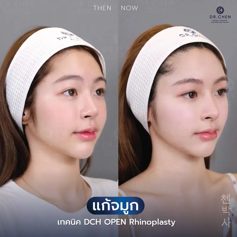แก้จมูกเทคนิค Open