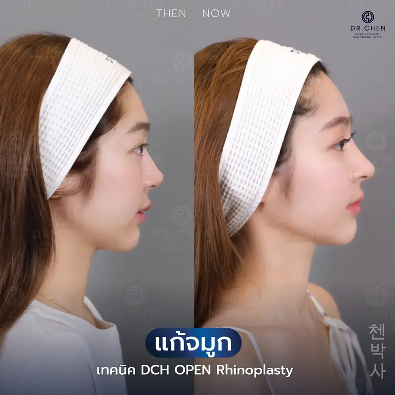 แก้จมูกเทคนิค Open