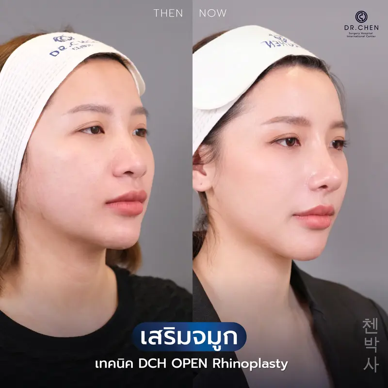แก้จมูกเทคนิค Open