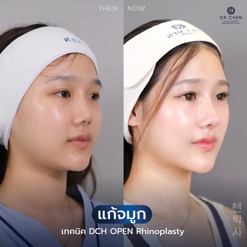 แก้จมูกเทคนิค Open