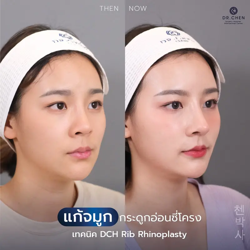 แก้จมูกซี่โครง