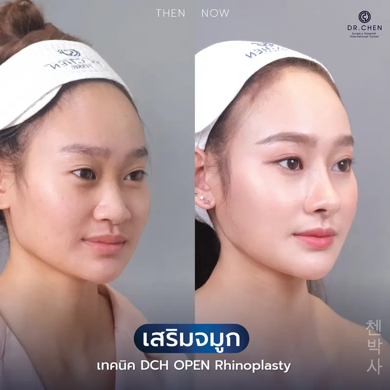 แก้จมูกเทคนิค Open