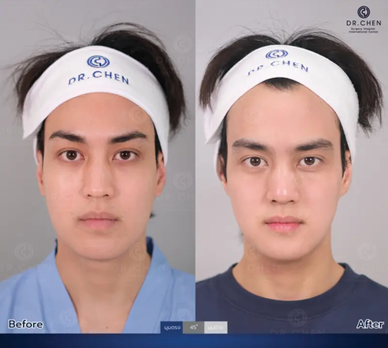รีวิวศัลยกรรมปรับโครงหน้า