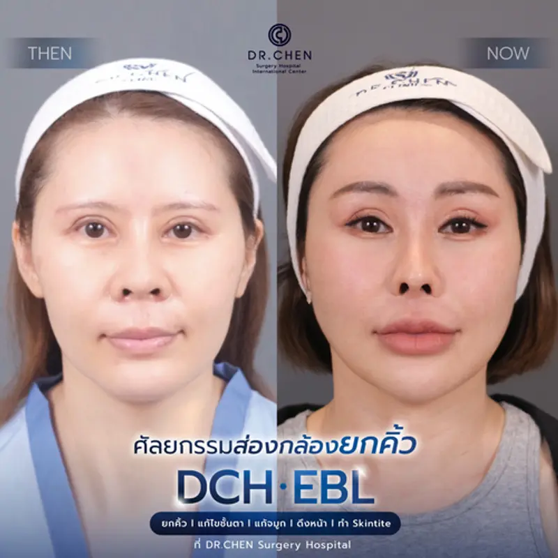 รีวิวศัลยกรรมยกคิ้ว
