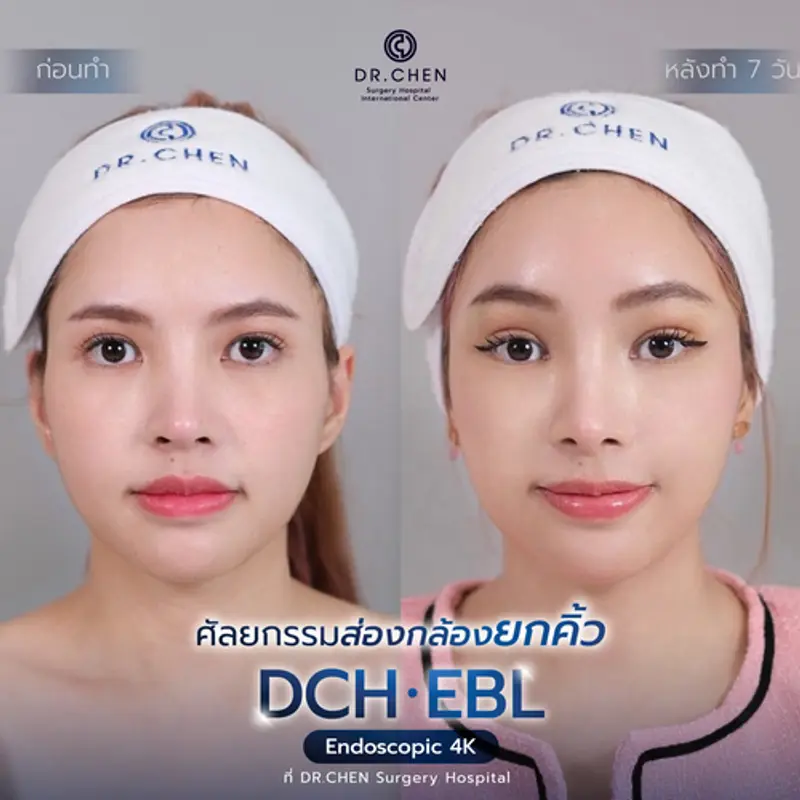 รีวิวศัลยกรรมยกคิ้ว
