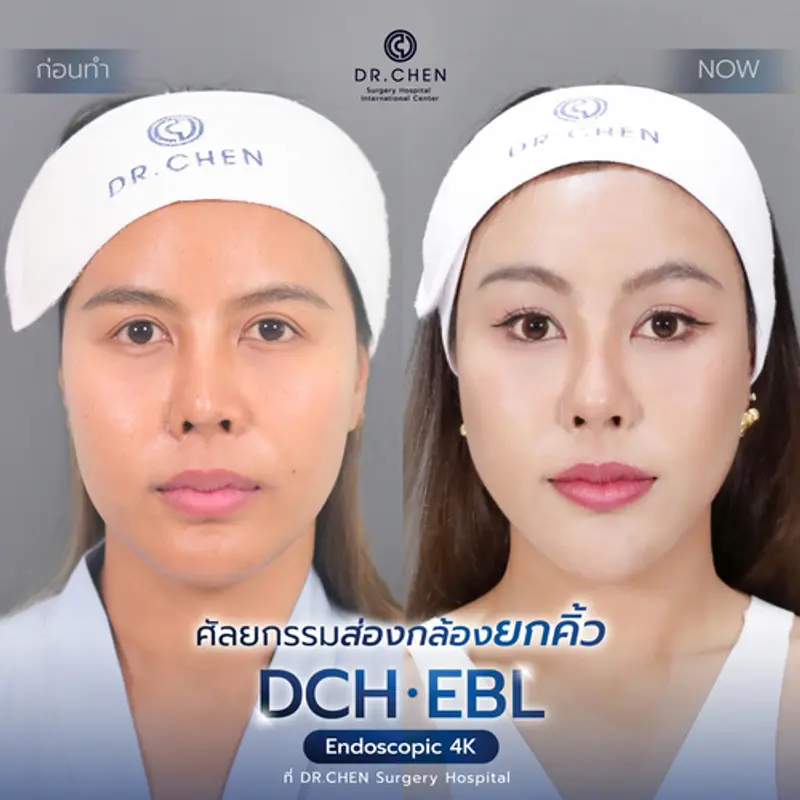 รีวิวศัลยกรรมยกคิ้ว