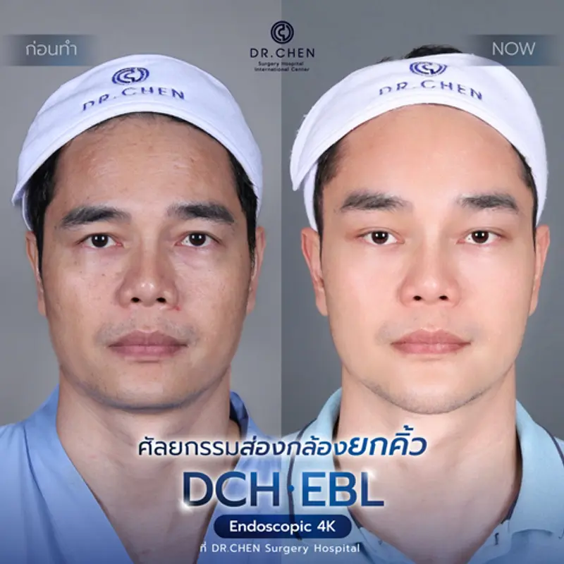 รีวิวศัลยกรรมยกคิ้ว