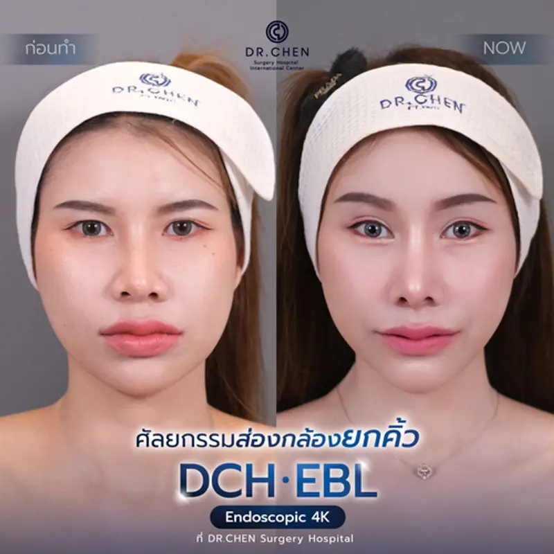 รีวิวศัลยกรรมยกคิ้ว