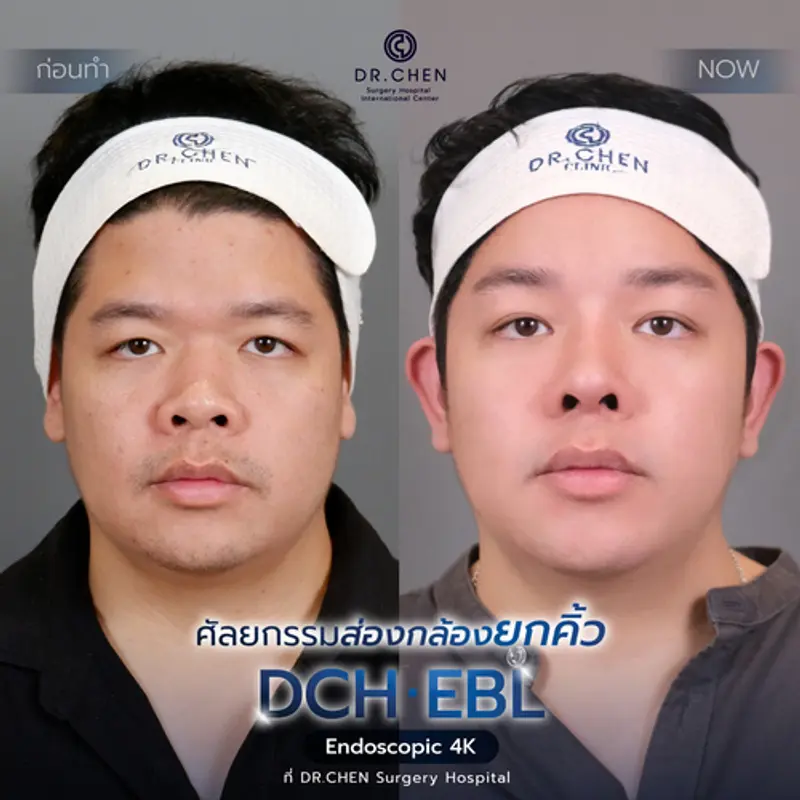 รีวิวศัลยกรรมยกคิ้ว
