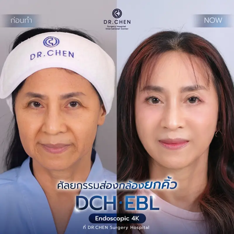รีวิวศัลยกรรมยกคิ้ว