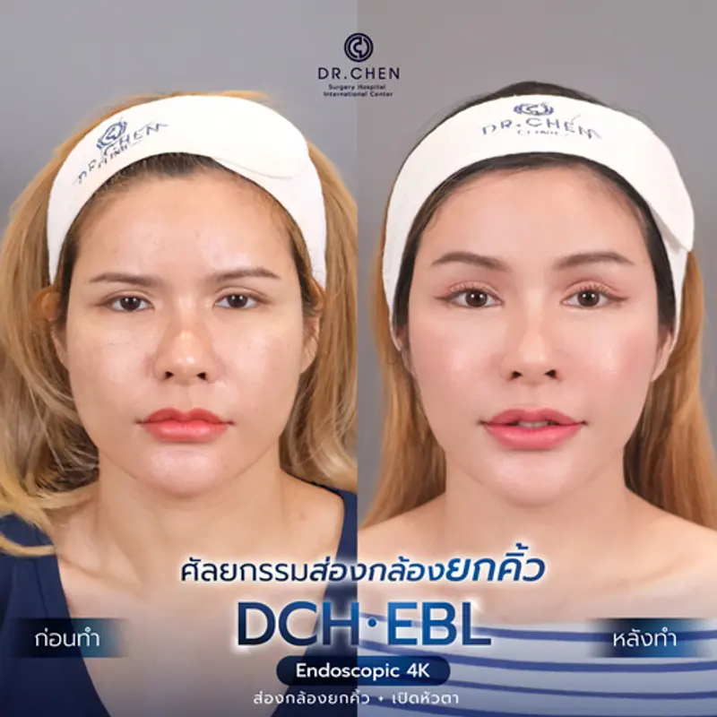 รีวิวศัลยกรรมยกคิ้ว