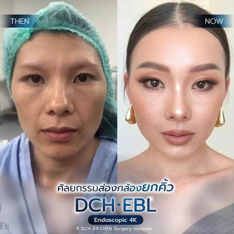 รีวิวศัลยกรรมยกคิ้ว