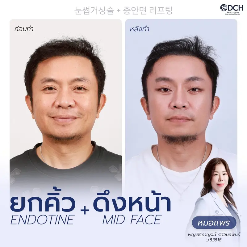รีวิวยกคิ้ว EBL และดึงหน้า Mid Face ก่อนหลัง