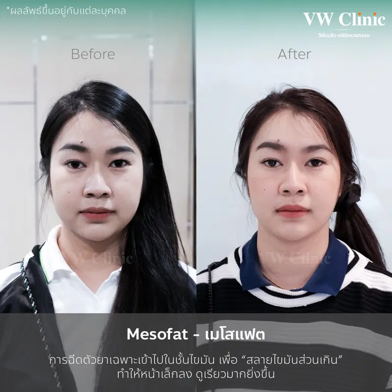 MesoFat