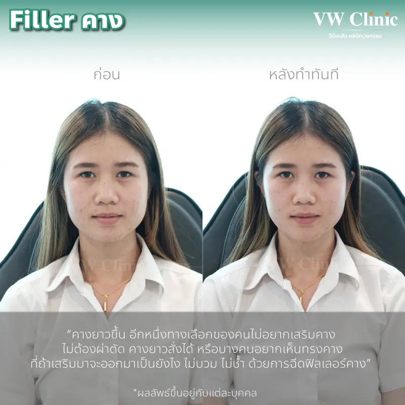Filler คาง