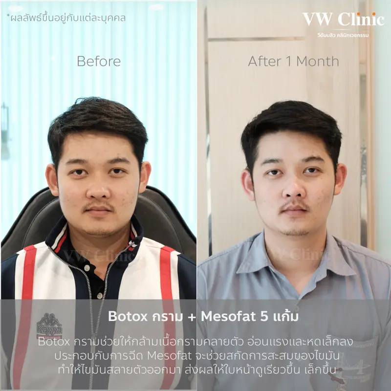 Botox กราม