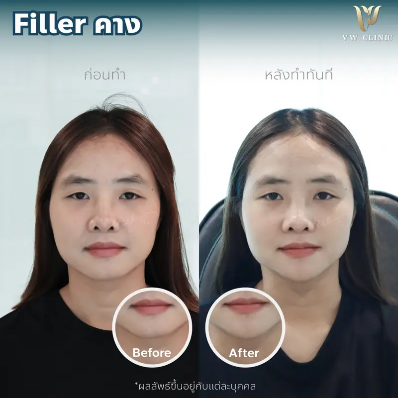 Filler คาง
