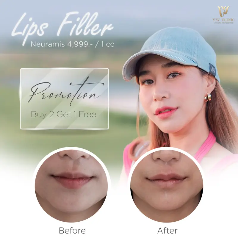 Filler ปาก 