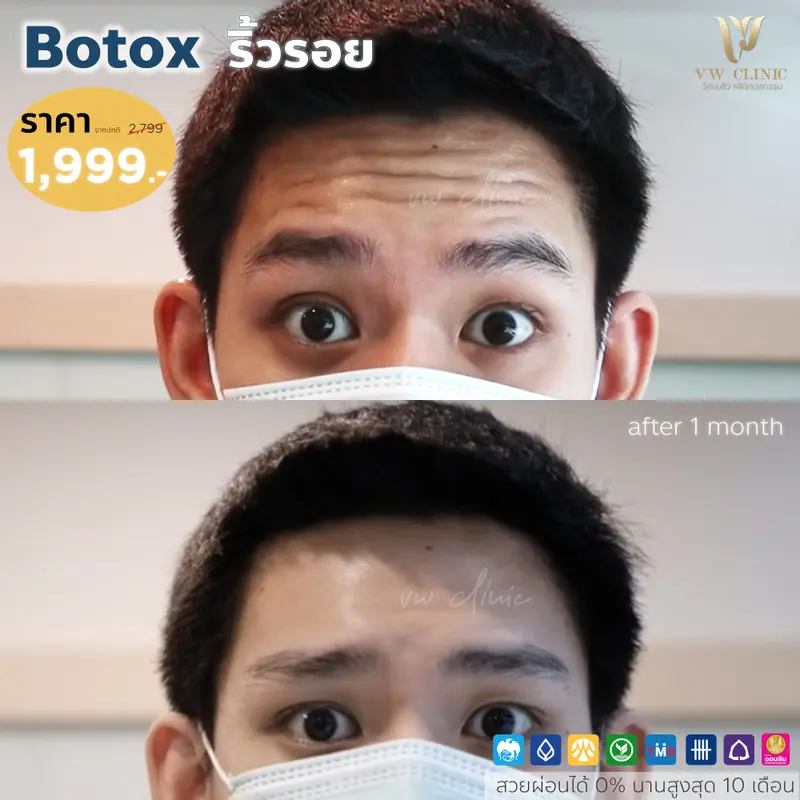 Botox ริ้วรอย