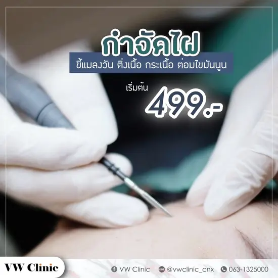 กำจัดไฝ ขี้แมลงวัน