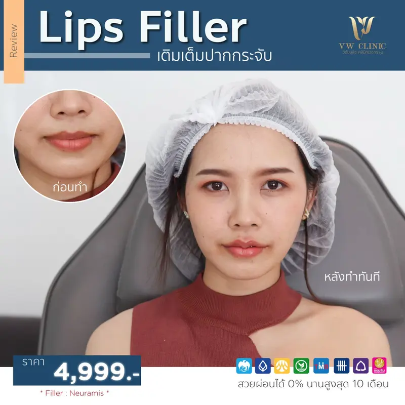 Filler ปาก
