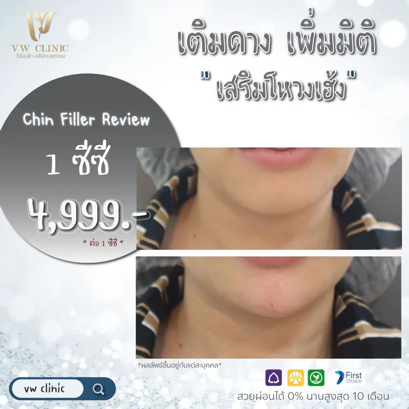 Filler คาง