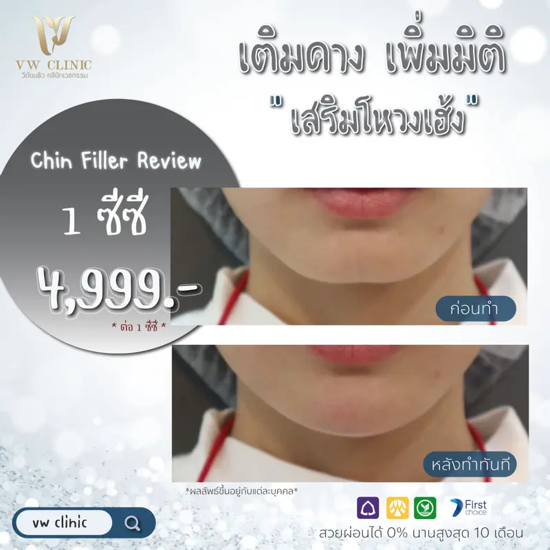 Filler คาง